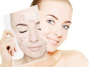 Isotretinoína y tretinoína, ¿cuál es mejor?